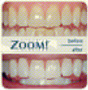 Teeth Whitening ,  Tooth whitening ,  Zoom Teeth whitening Calgary