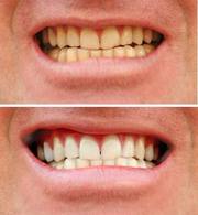 GTA Toronto Teeth Whitening Course