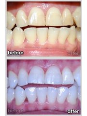 Toronto GTA Inexpensive Teeth Whitening Training