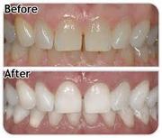 Toronto GTA Teeth Whitening Training