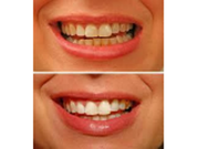 TEETH WHITENING TRAINING by Canada's finest