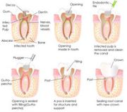 Root Canal Treatment Richmond Hill,  Toronto