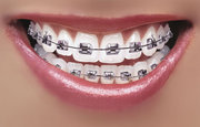 Teeth whitening in Etobicoke