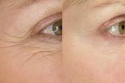 Choose The Right Treatment For Facial Lines