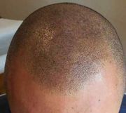 Baldness and Thin Hair Treatment SMP - Scalp Micro-Pigmentation Watch|
