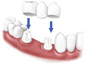 Teeth Whitening Porcelain Veneers of Lakeshore in  Mississauga