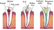 Procedures Of A Root Canal Therapy Cost in Lakeshore Mississauga