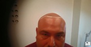 Bald Men or Thinning Hair? Get a Medical Scalp Tattoo. Get your Confid