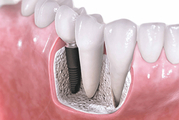 Fill The Gaps in Your Smile with Dental Crowns & Bridges