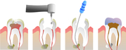 Your Toothache May Need a Root Canal Treatment