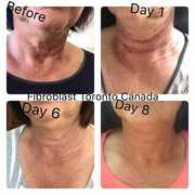  FIBROBLAST PLASMALIFT TRAINING (DEC 2)