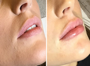 Lip Filler