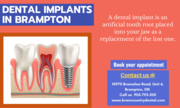 Dental Implants Treatment in Brampton,  ON