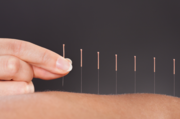 Acupuncture For Headaches Calgary SW
