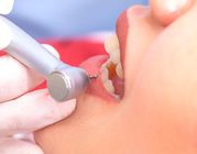 Teeth Cleaning Services Calgary