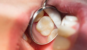 White Fillings in Kitchener | Composite Fillings in Kitchener