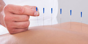 Best Acupuncture Treatment in Thornhill: Healing With Needles