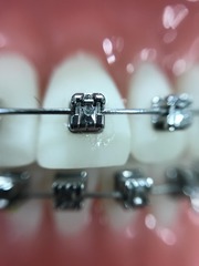 Orthodontic Braces in Calgary NE
