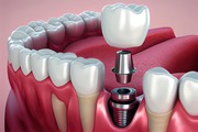 Dental Implants In Calgary