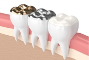Dental Filling Services in Calgary